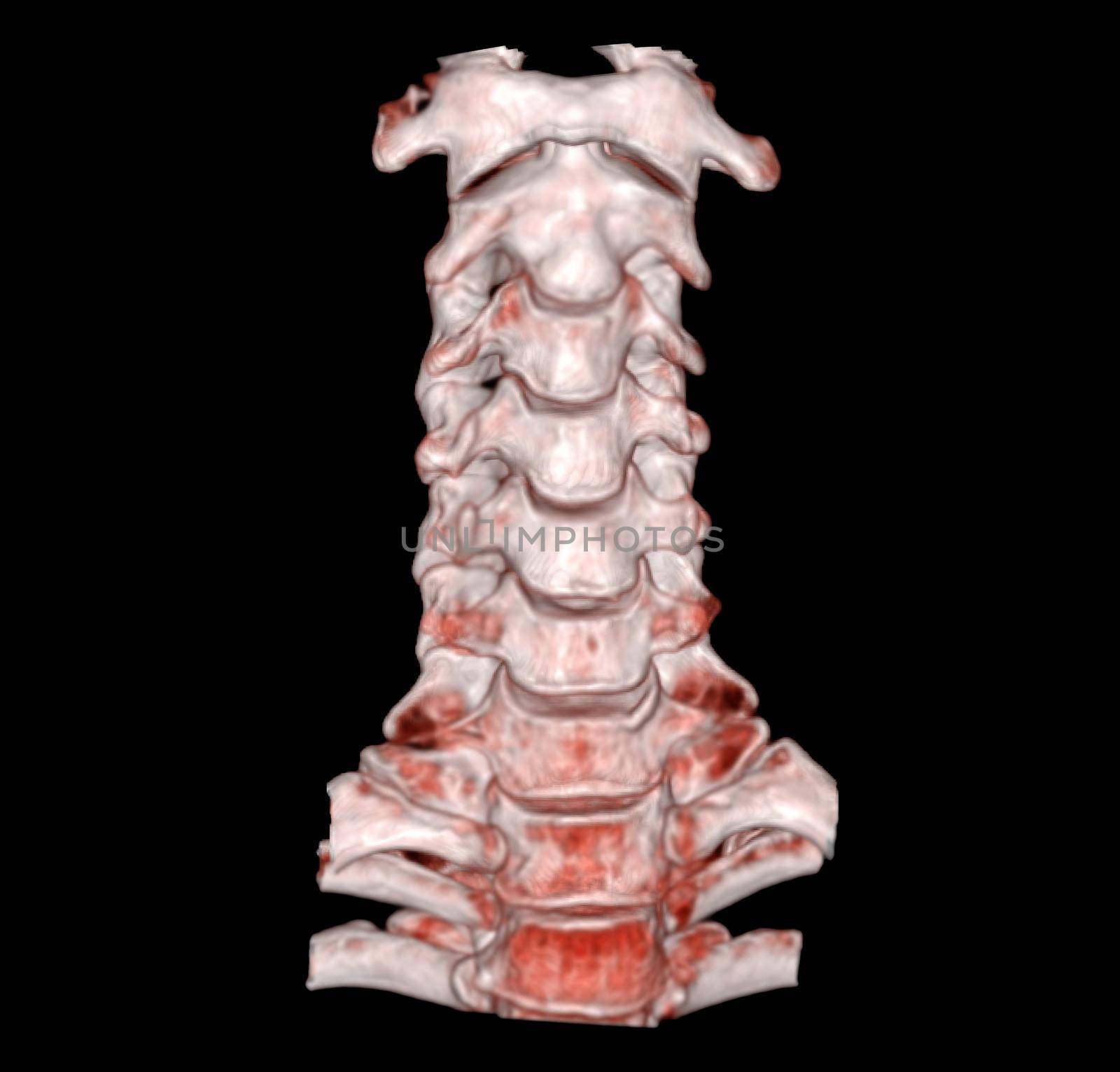 CT SCAN of Cervical Spine 3D rendering . by samunella