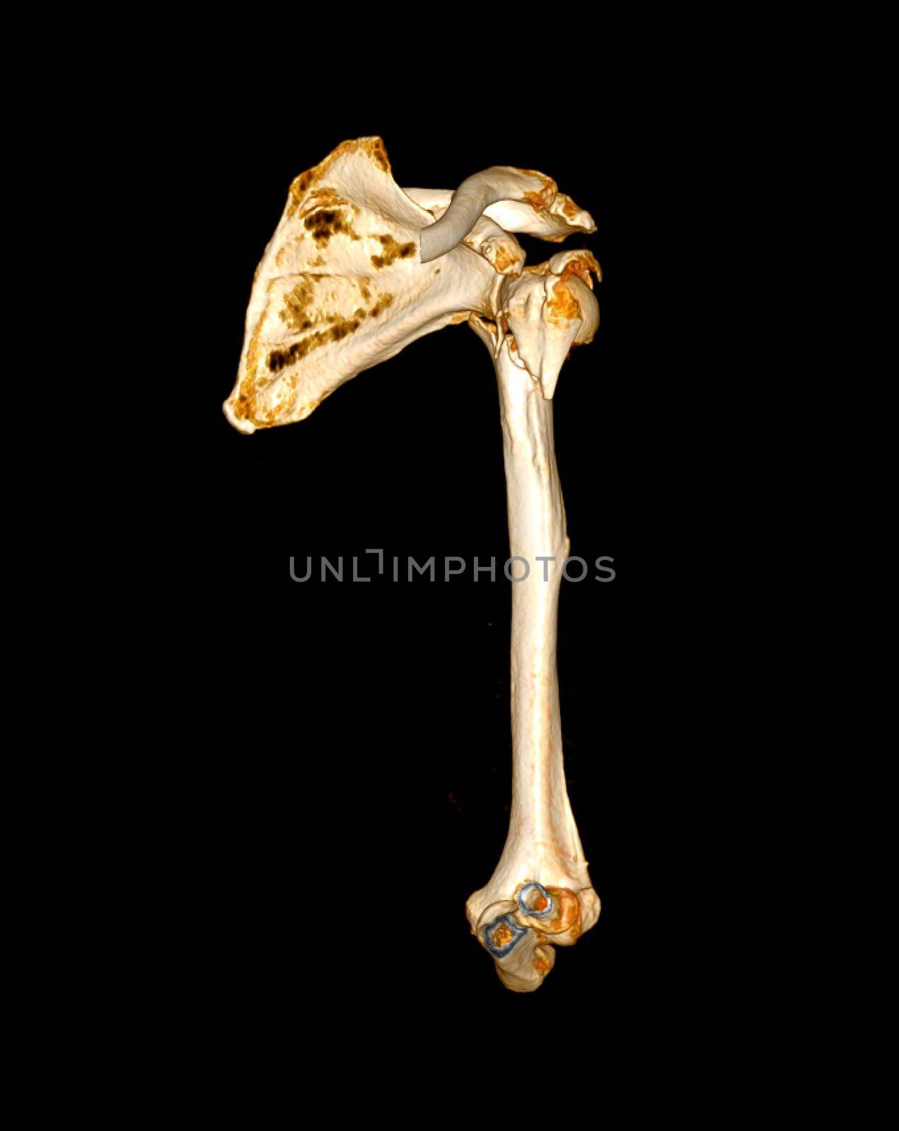 Computed Tomography Volume Rendering examination of the shoulder joint and humerus bone 3D rendering in patient fracture shoulder joint and humerus bone .