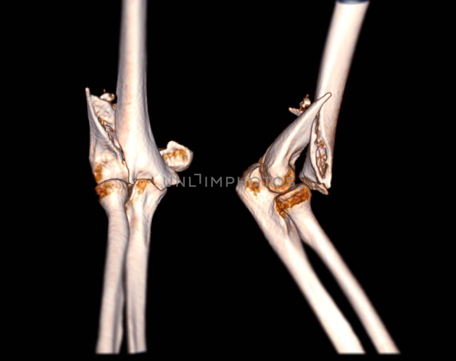 Computed Tomography Volume Rendering examination of elbow joint 3D rendering in patient fracture elbow joint.