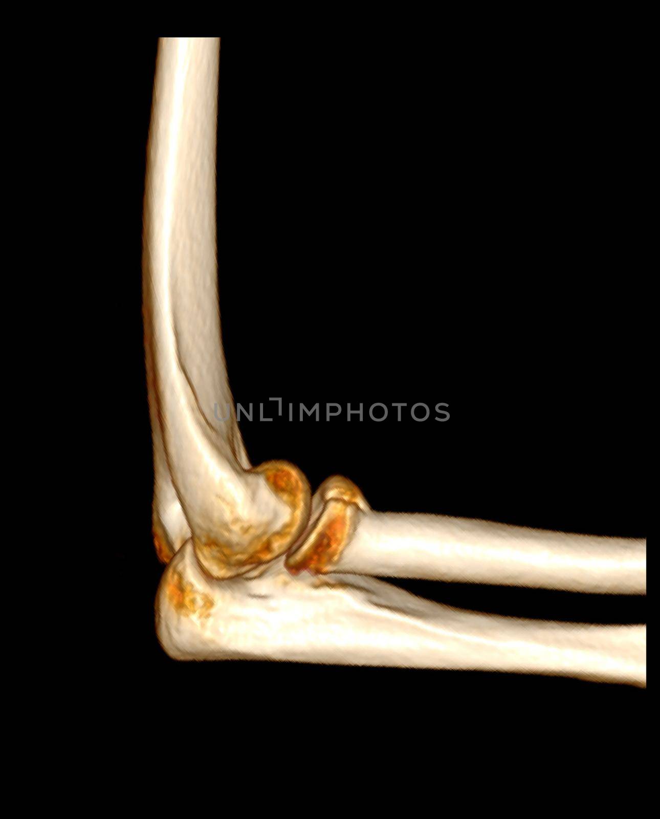 Computed Tomography Volume Rendering examination of elbow joint 3D rendering in patient fracture elbow joint.