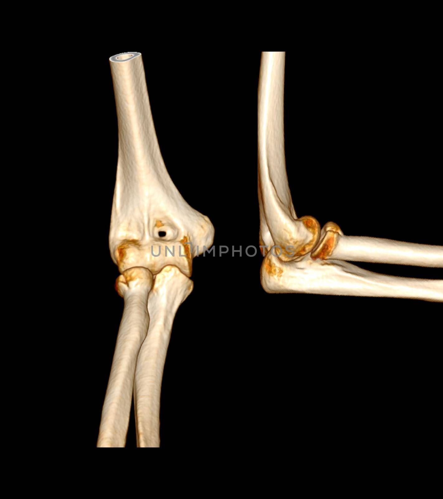 Computed Tomography Volume Rendering examination of elbow joint 3D rendering in patient fracture elbow joint.