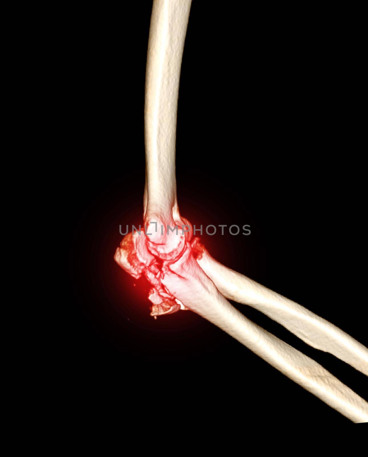 Computed Tomography Volume Rendering examination of elbow joint 3D rendering in patient fracture elbow joint.