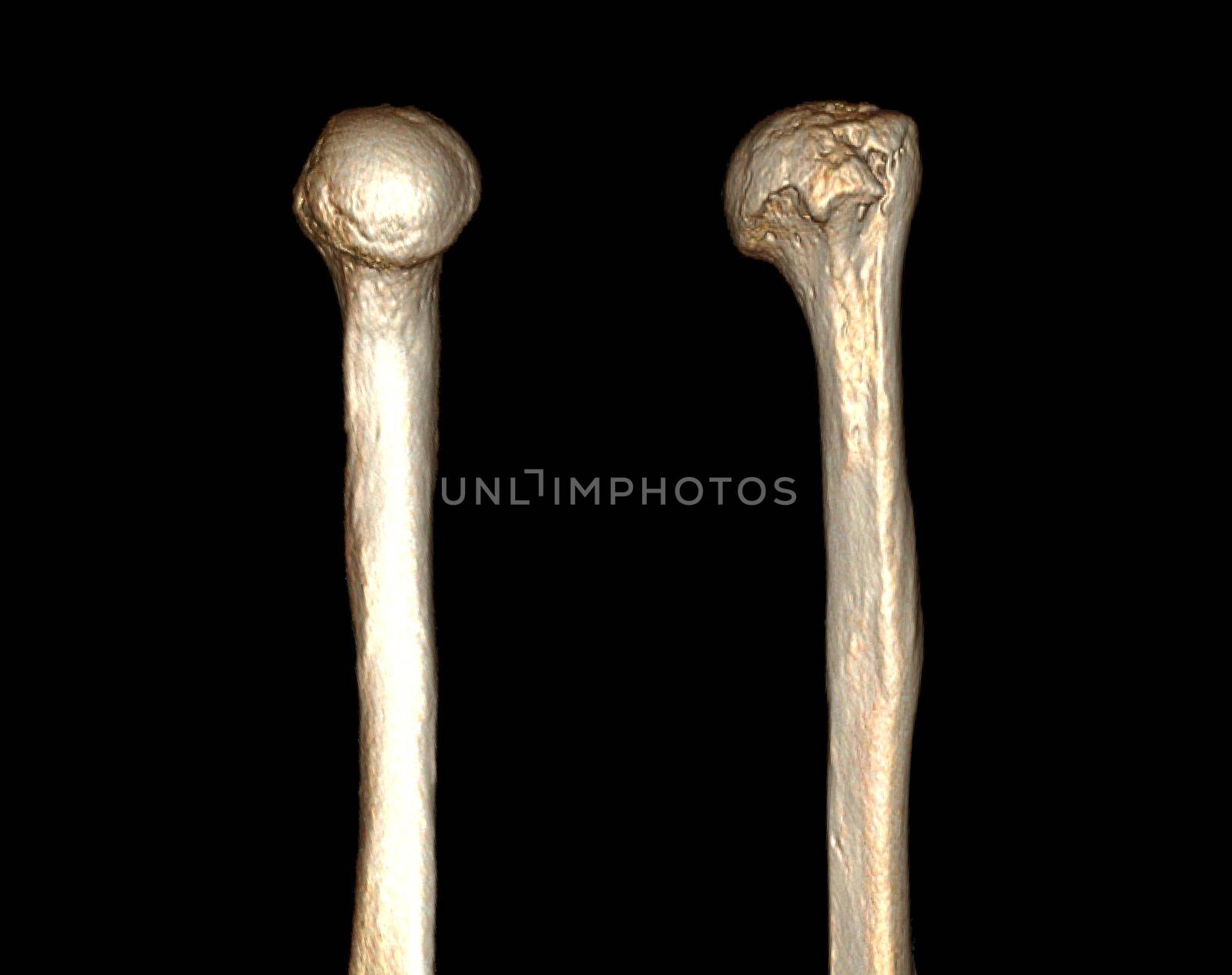 Computed Tomography Volume Rendering examination of the shoulder joint and humerus bone 3D rendering in patient fracture shoulder joint and humerus bone .