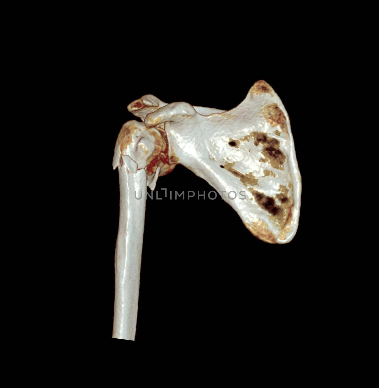 Computed Tomography Volume Rendering examination of the Shoulder 3D rendering in patient fracture shoulder joint.