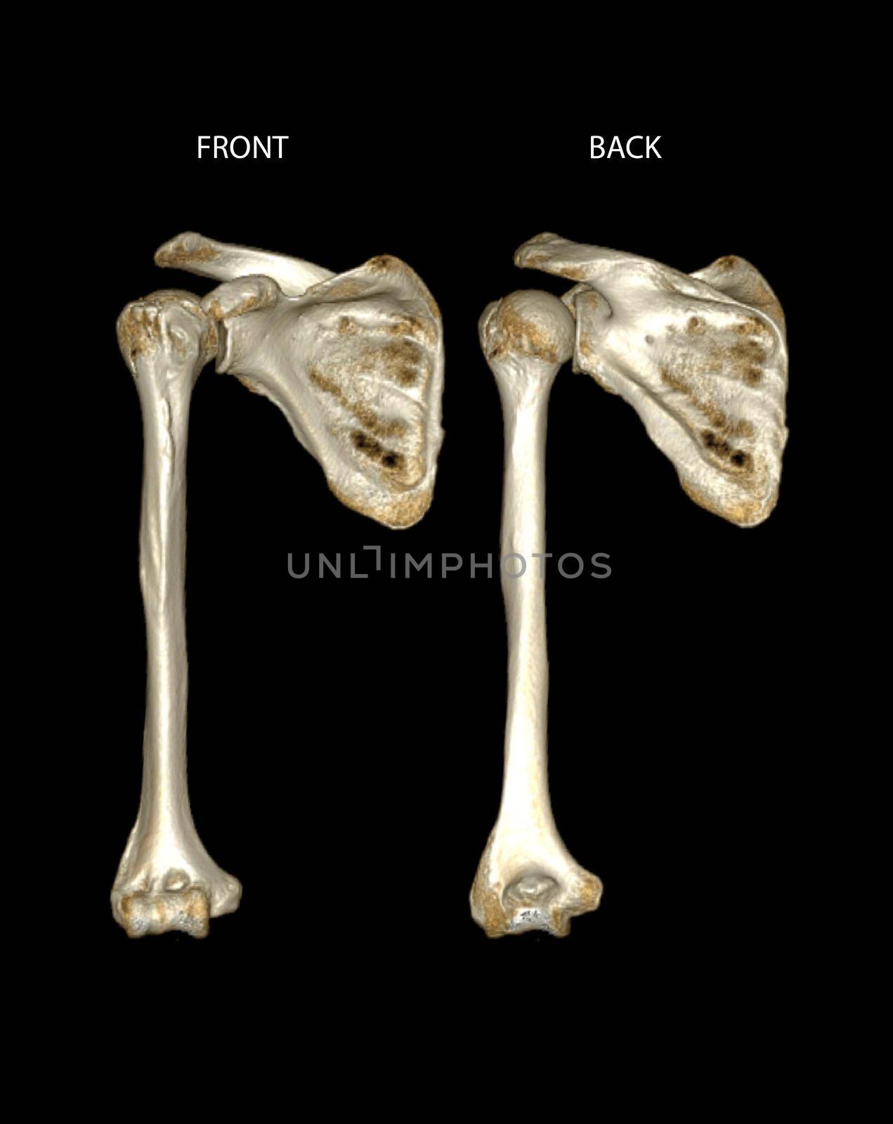 Computed Tomography Volume Rendering examination of the shoulder joint and humerus bone 3D rendering in patient fracture shoulder joint and humerus bone .