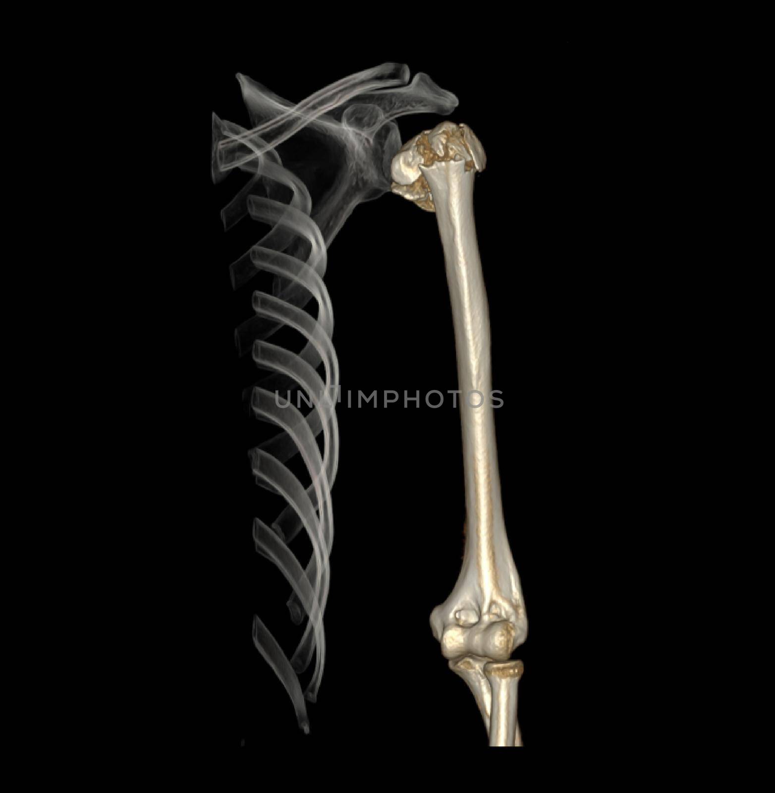 Computed Tomography Volume Rendering examination of the shoulder joint and humerus bone 3D rendering in patient fracture shoulder joint and humerus bone .