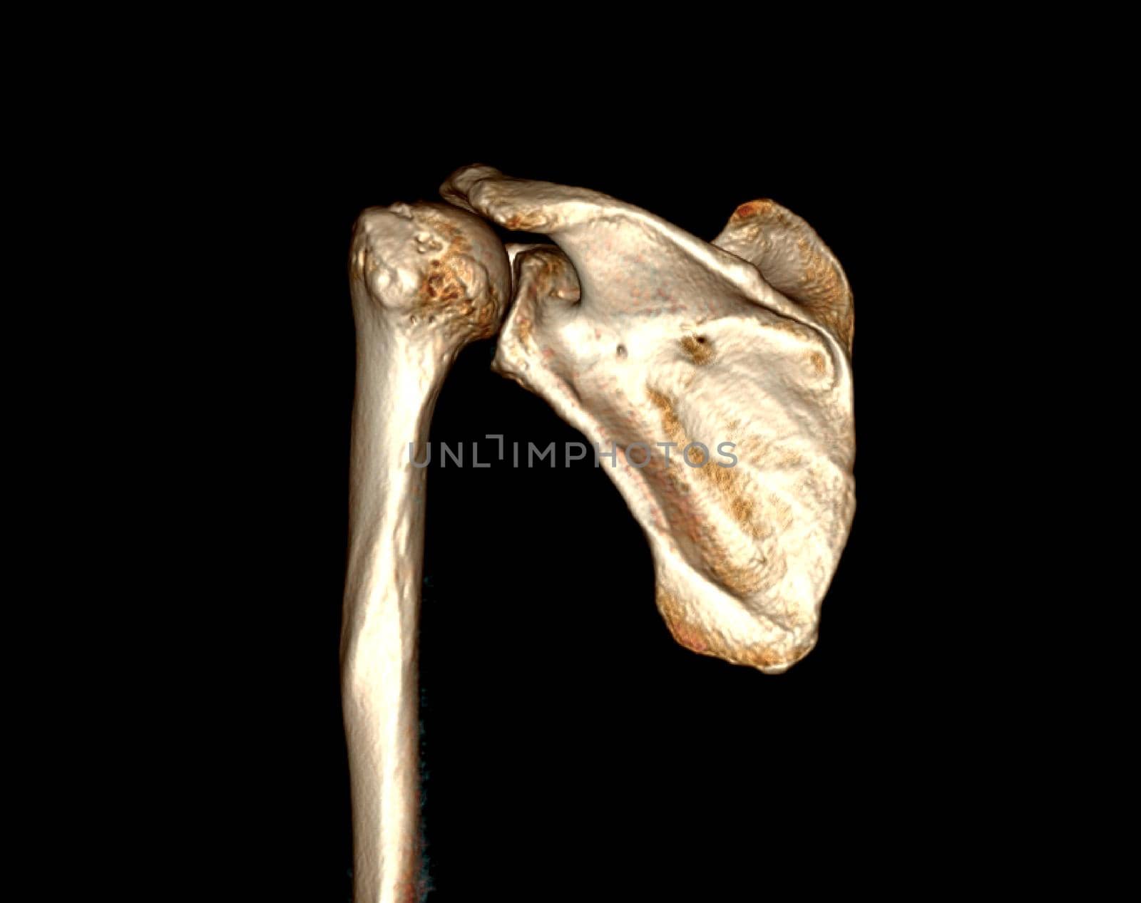 CT scan of shoulder joint. by samunella