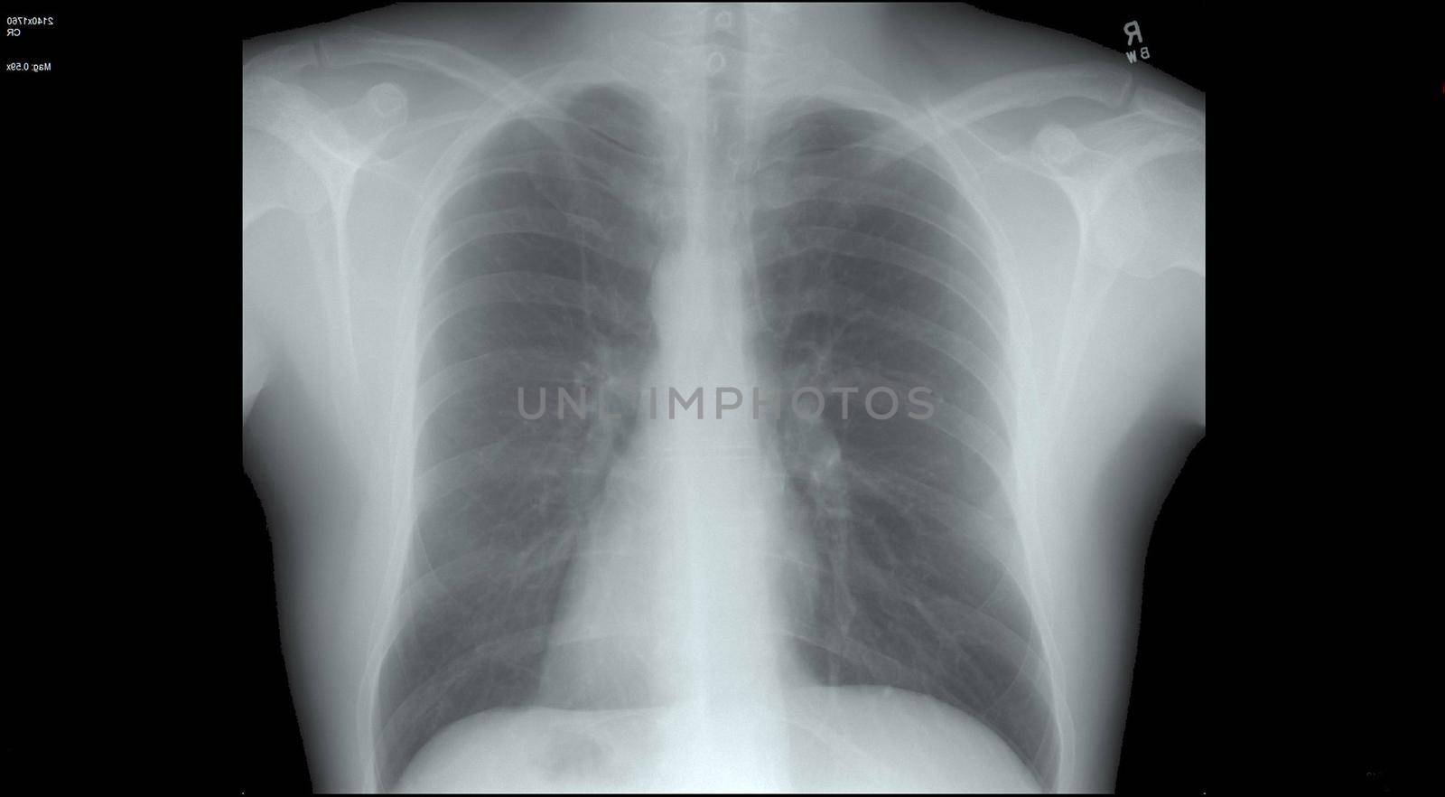 Chest x-ray of the human body over a black background for coronavirus or Covid-19 concepts