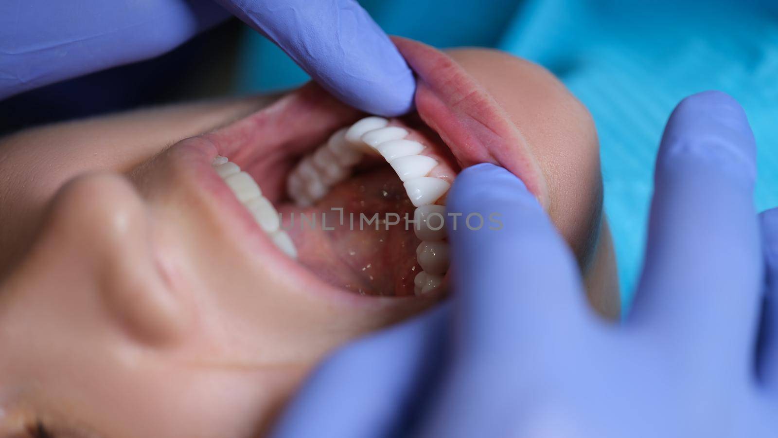 Doctor dentist examining patient oral cavity with veneers closeup by kuprevich