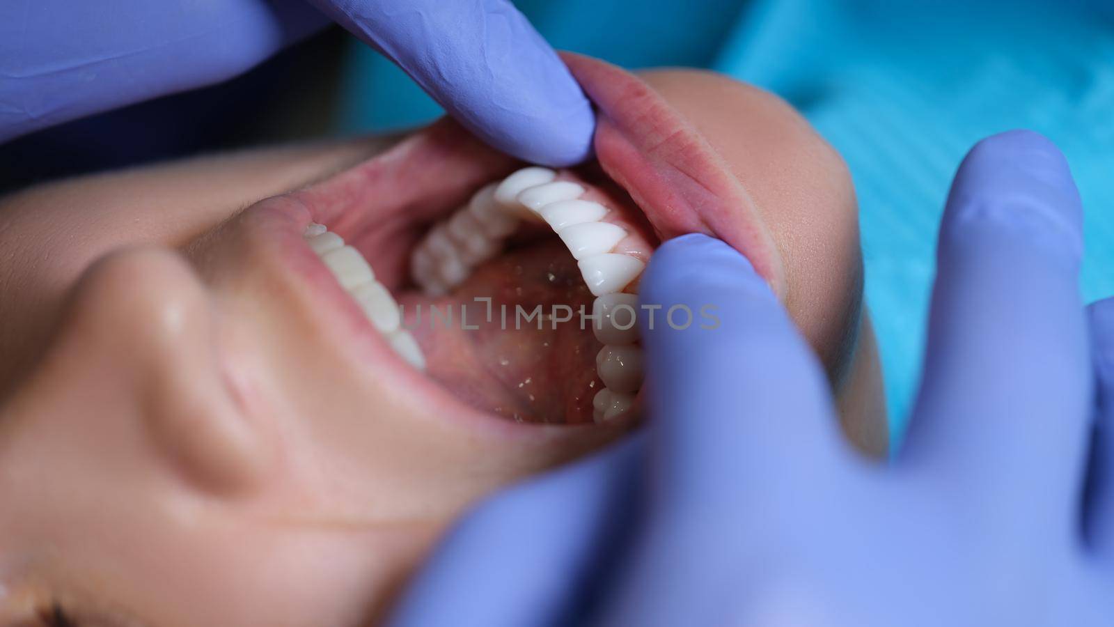 Doctor dentist examining patient oral cavity with veneers closeup. Installation of composite and zirconium veneers concept