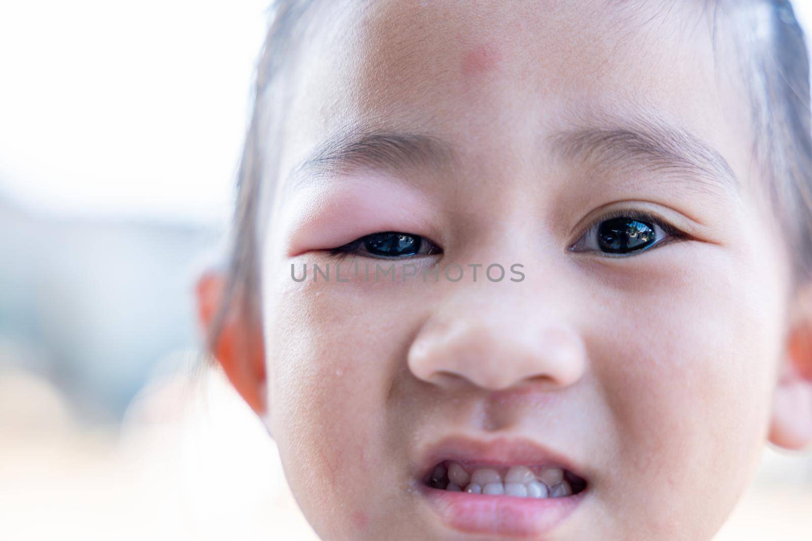 Stye Eye diseases. Closed Asian kid little girl eye with sty, eyelid abscess ophthalmic hordeolum