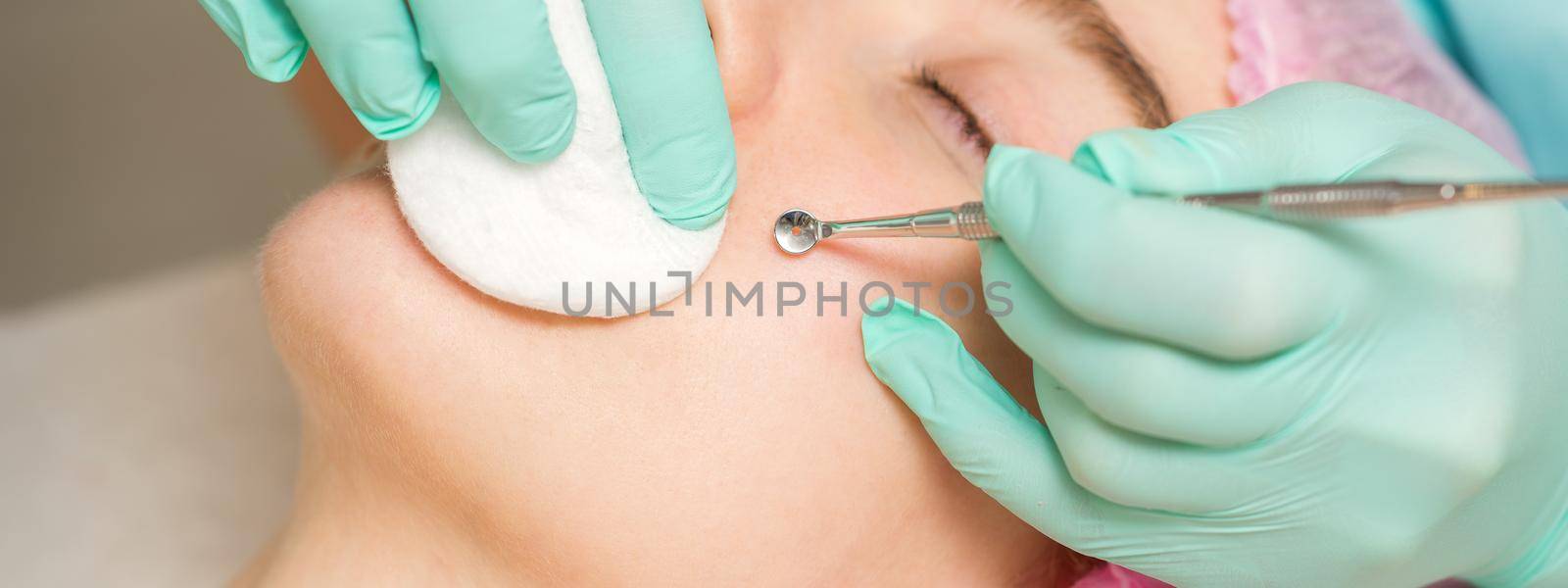 The beautician removes blackhead and acne on the female face in a beauty salon, blackhead removal tool. by okskukuruza