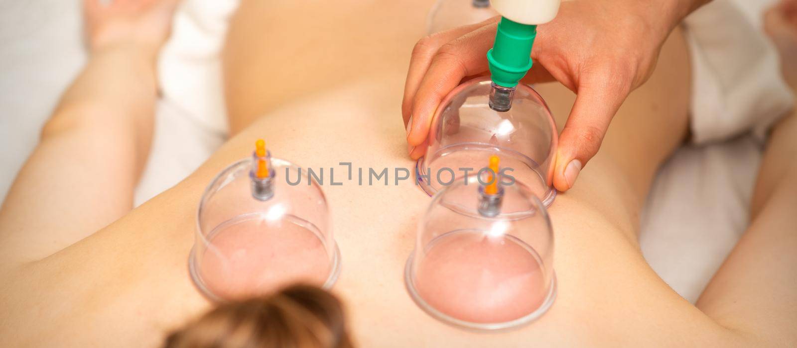 Acupuncture woman therapist placing the cup on the back of a female patient. by okskukuruza