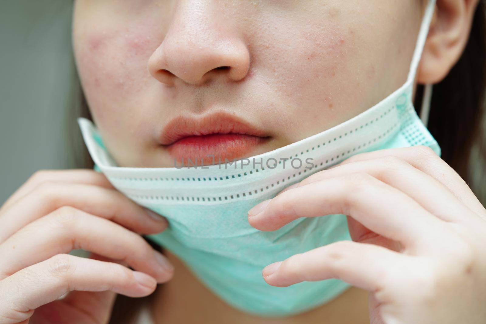Acne pimple and scar on skin face, disorders of sebaceous glands, teenage girl skincare beauty problem.