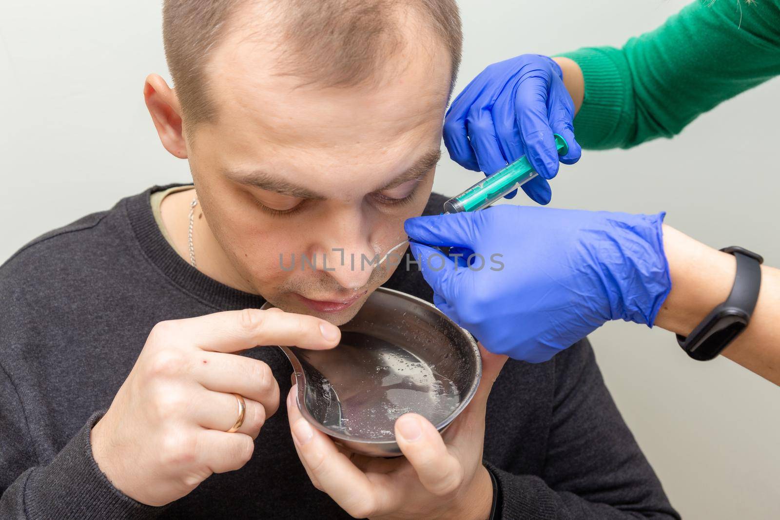 A nurse rinses the nasal cavity of a patient suffering from sinusitis with saline solution using a syringe.