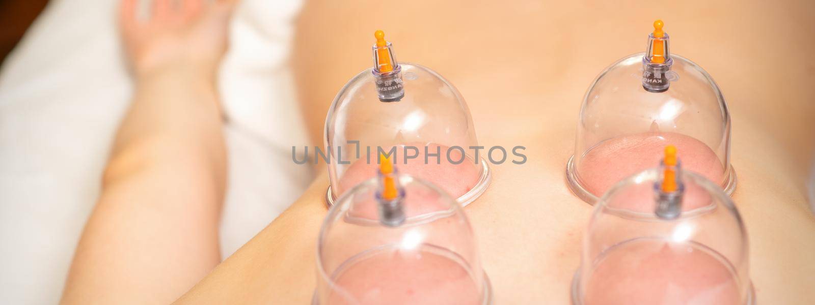 Young caucasian woman receiving cupping therapy in spa clinic. Islamic female medicine. by okskukuruza