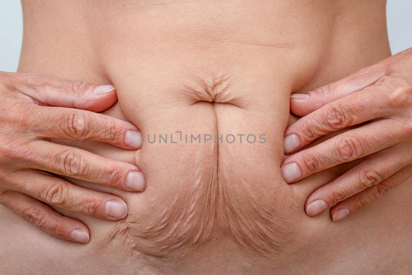 Hands on belly pressed skin to show sagging skin after diet and stretch marks after pregnancy by TatianaFoxy