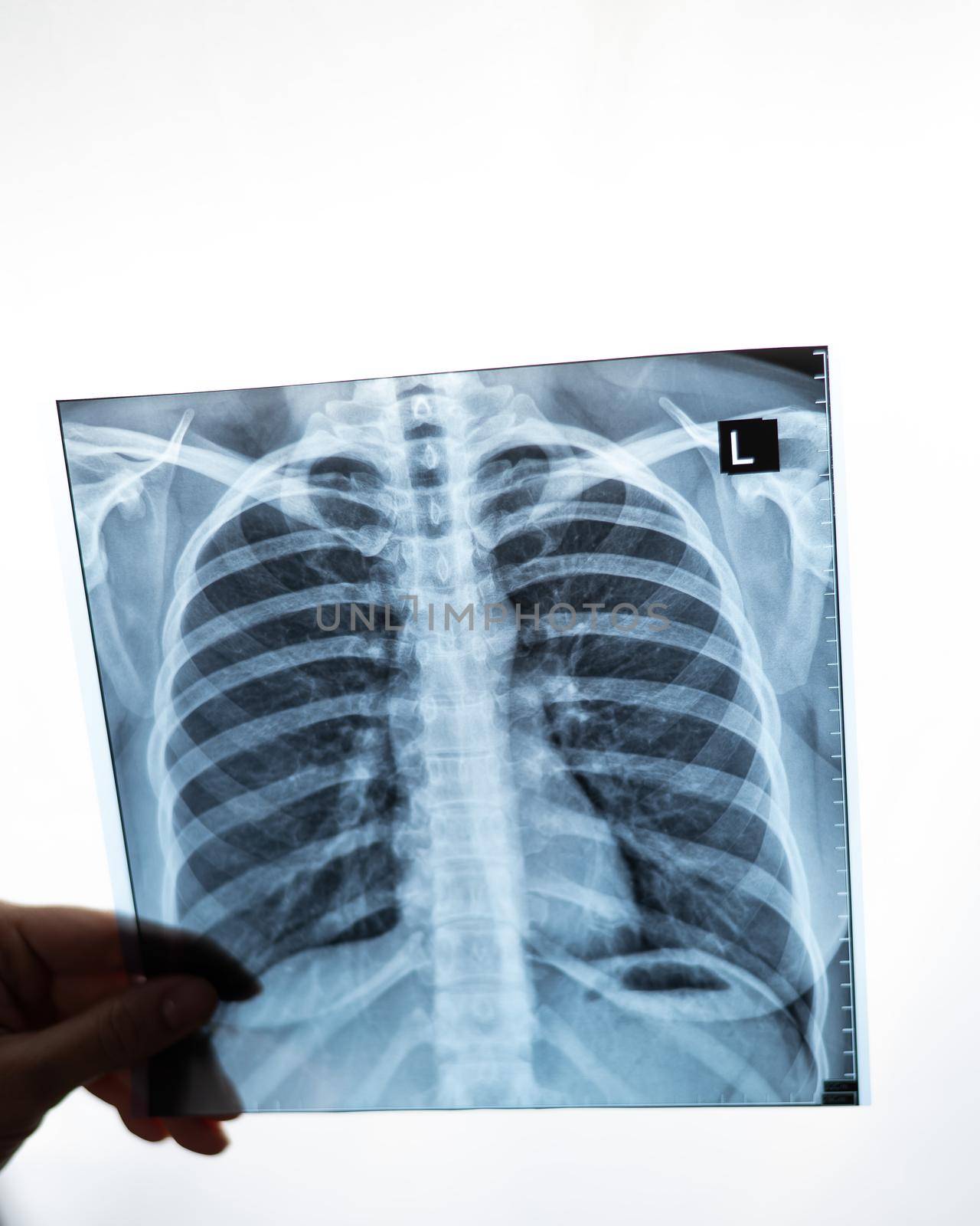 Doctor showing x-ray of patient's lungs. by mrwed54