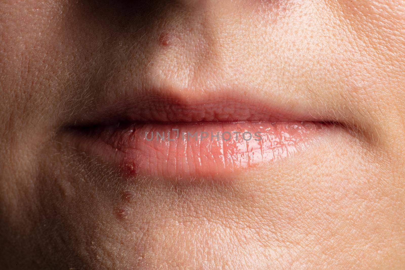 human lips close up with pimples on the face.