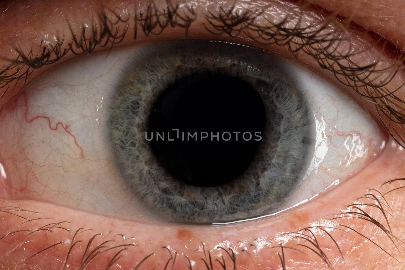 eye with large pupil.
