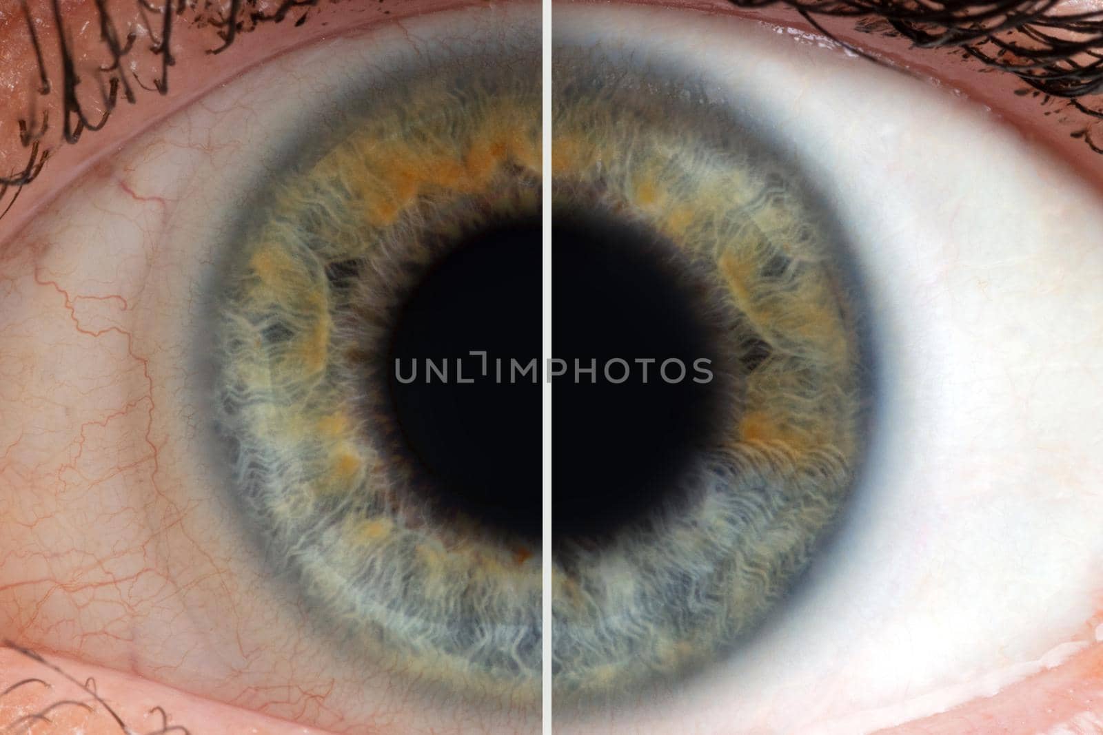 human eye with blood vessels before and after.