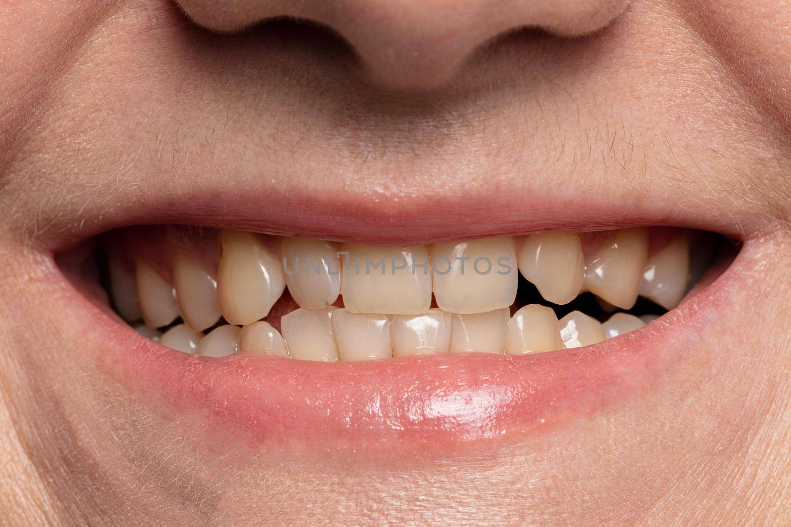 close-up smile with yellow teeth before whitening by TRMK