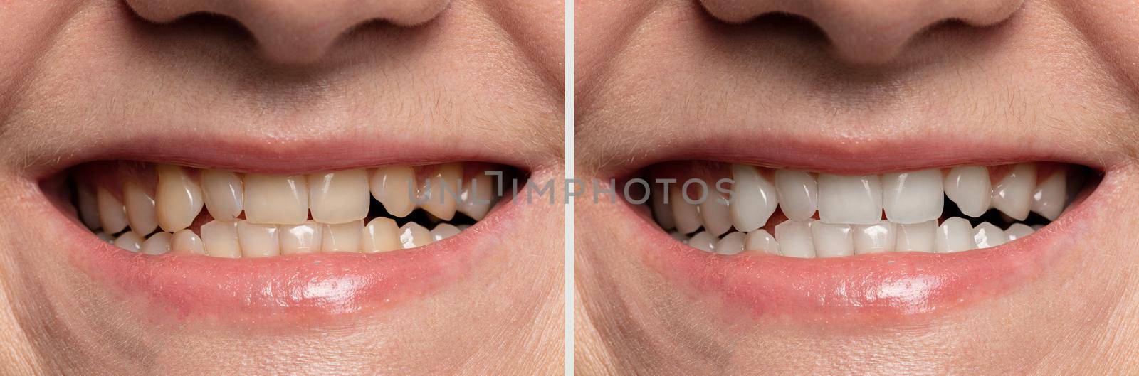 teeth whitening before and after close-up.