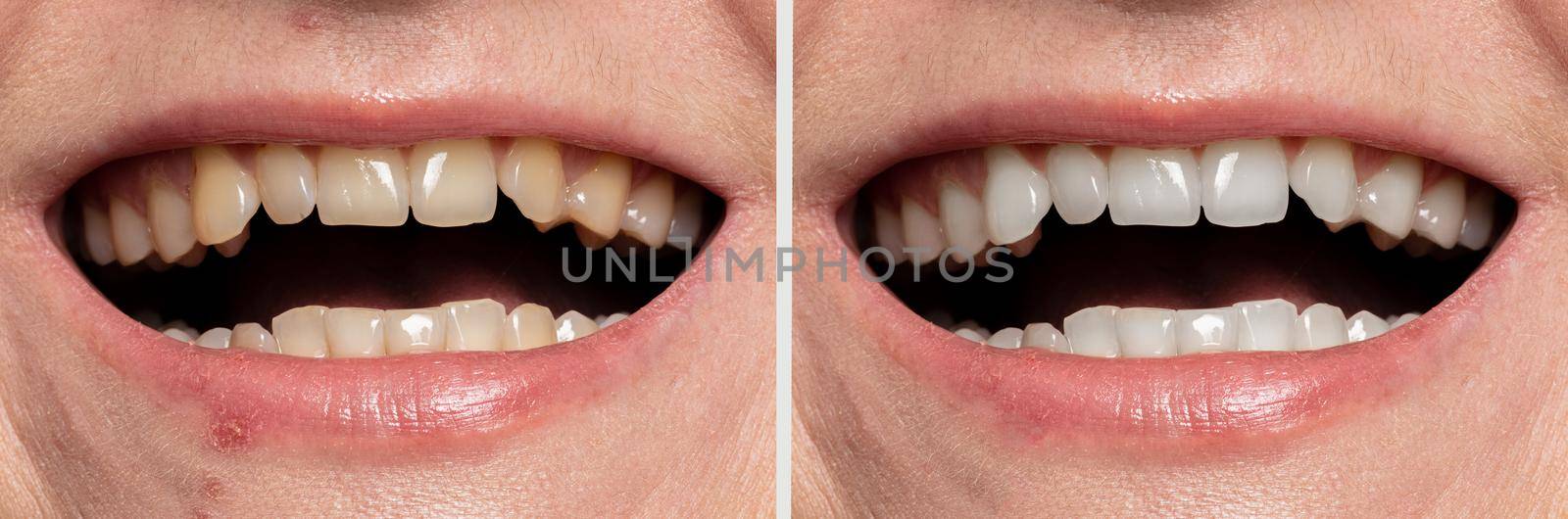 teeth whitening before and after.