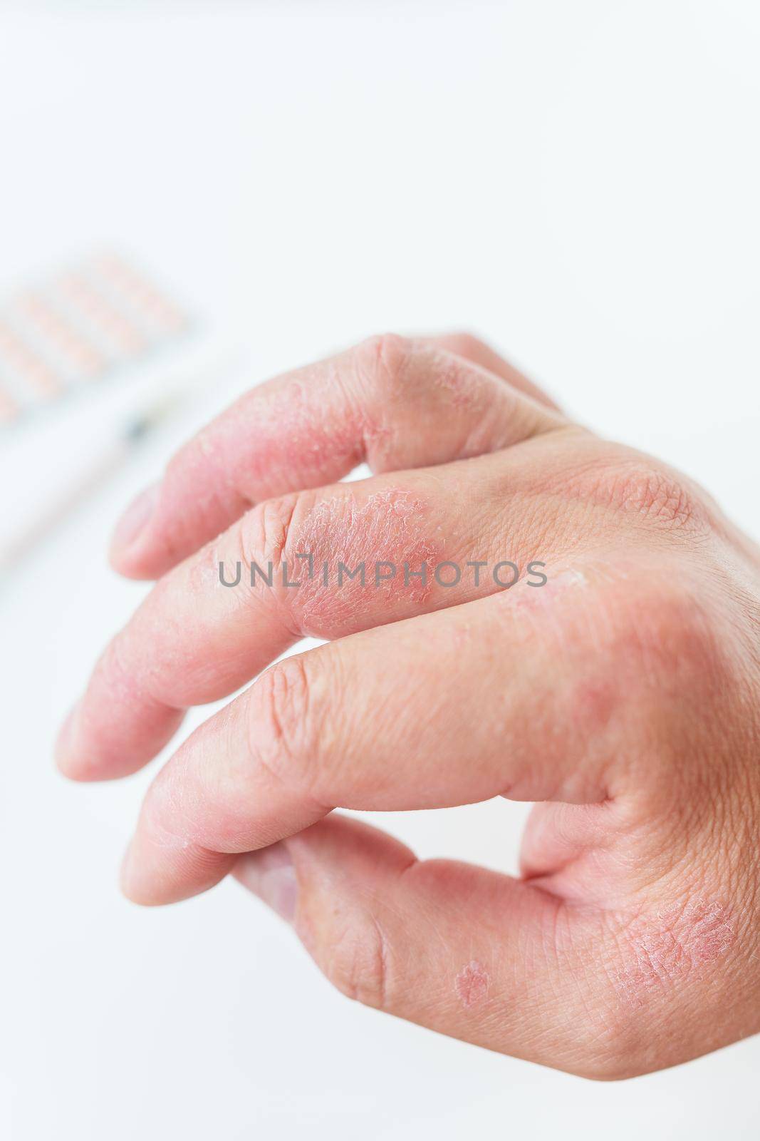 A man shows a reddening rash on his hands. The causes of itchy skin can be dermatitis (eczema), dry skin, burns, food allergies. healthcare concept