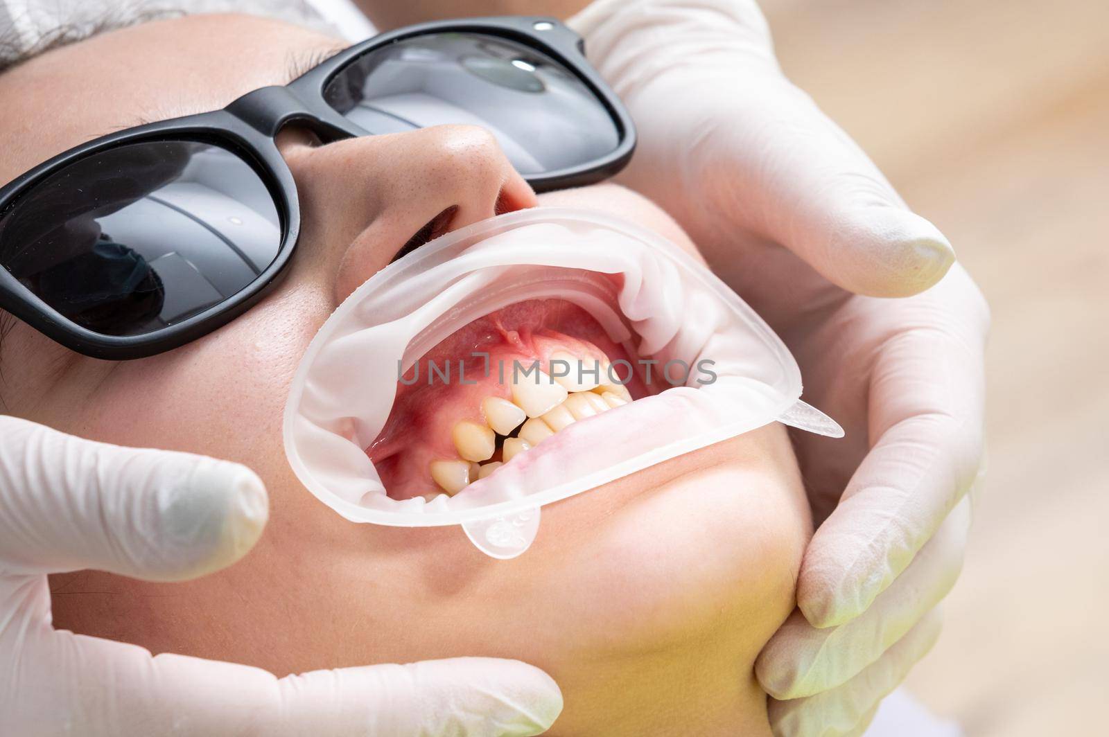 Patient with cheek retractor lying in dentist office in modern clinic