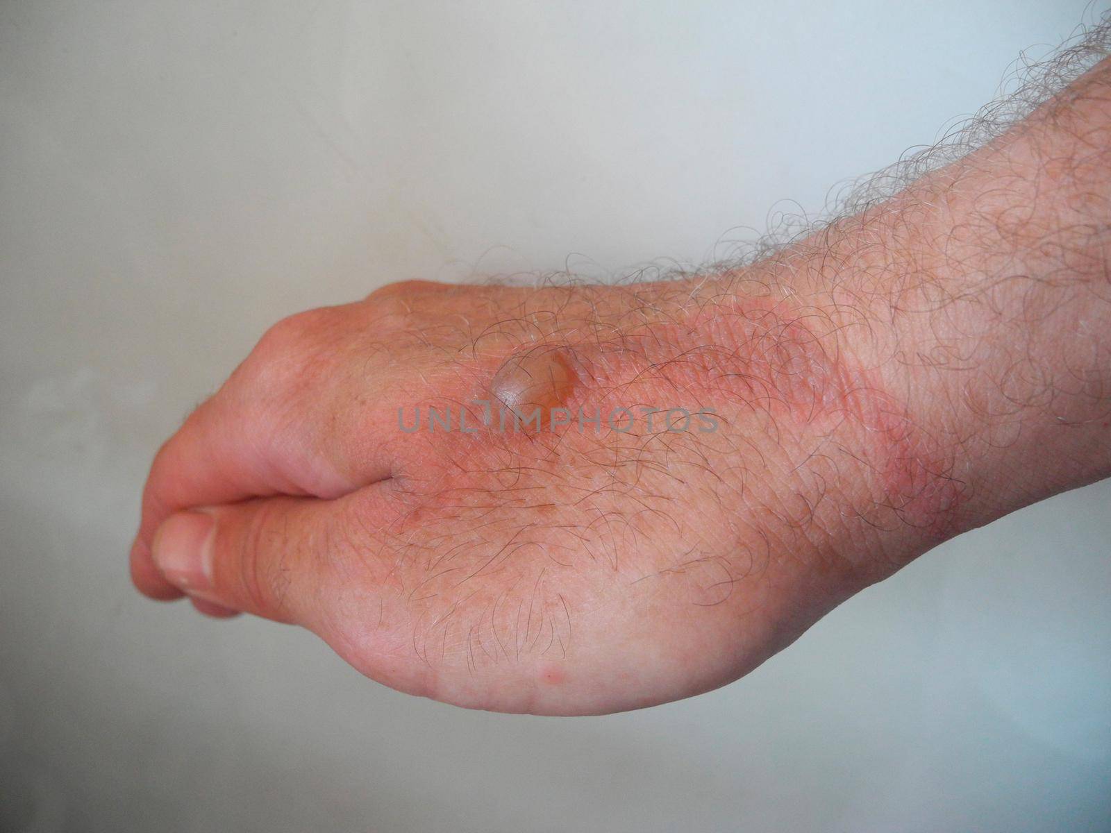 Horrible burns on male hand on gray background.