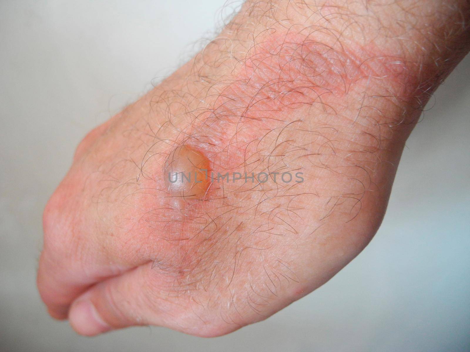 Horrible burns on male hand on gray background.