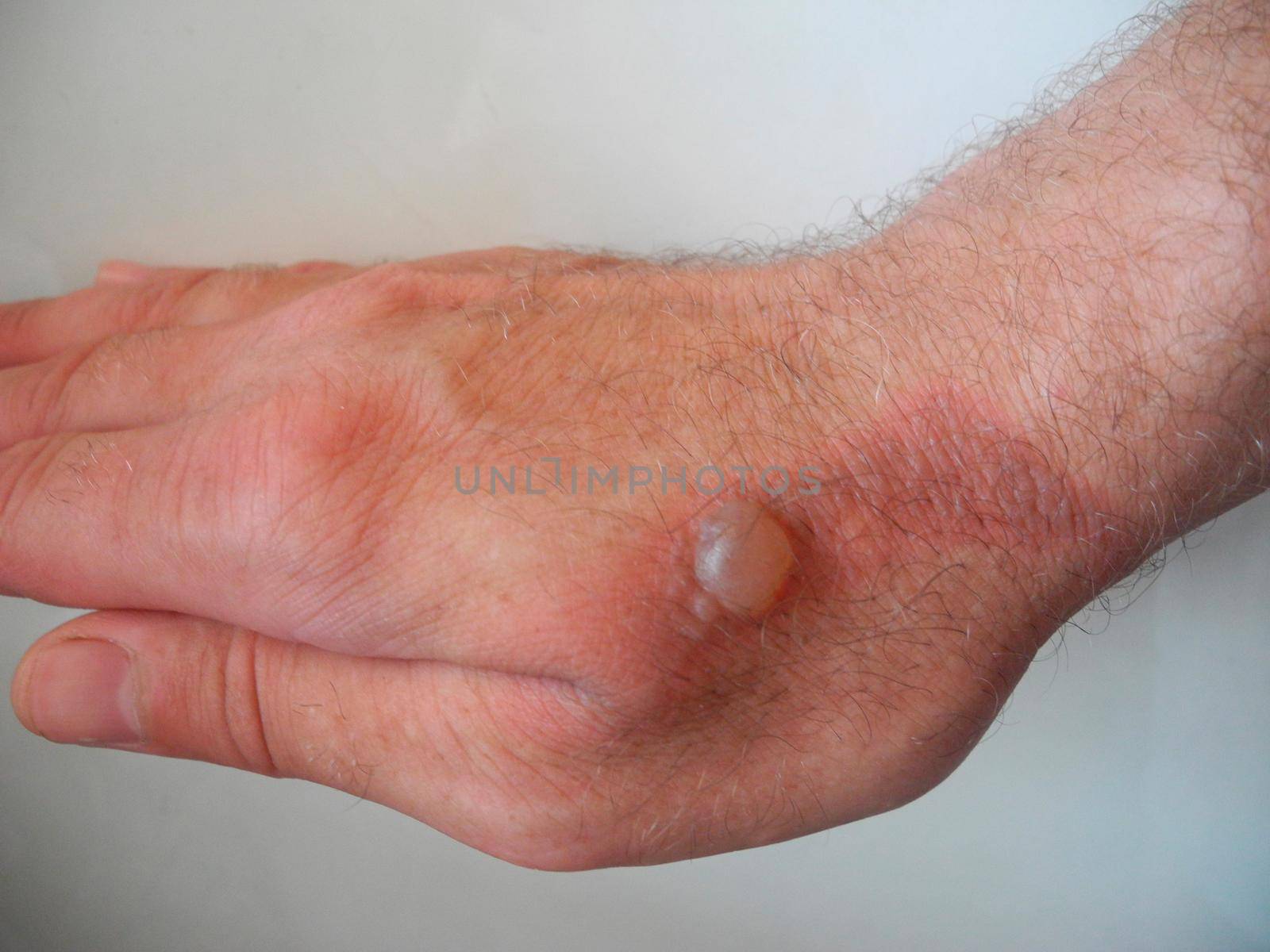 Horrible burns on male hand on gray background.