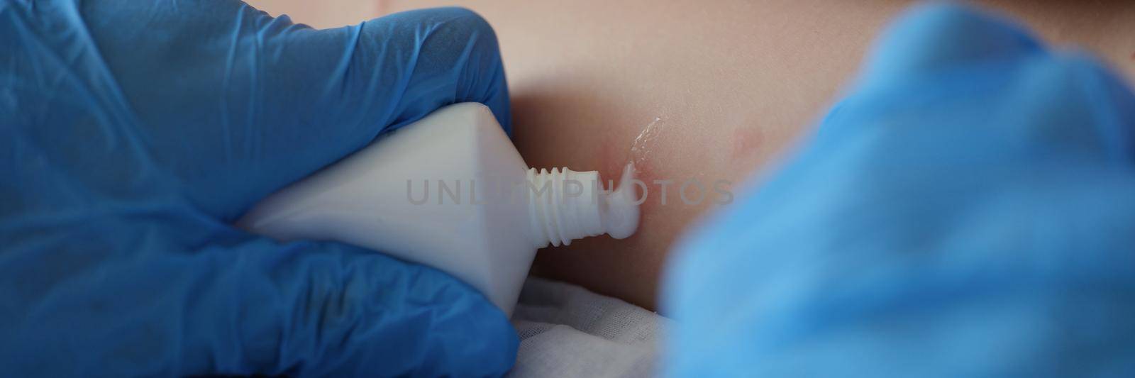 Close-up of doctor examine red rash on kid legs in hospital and apply cream from tube. Child on appointment, irritation on body. Medicine, health concept