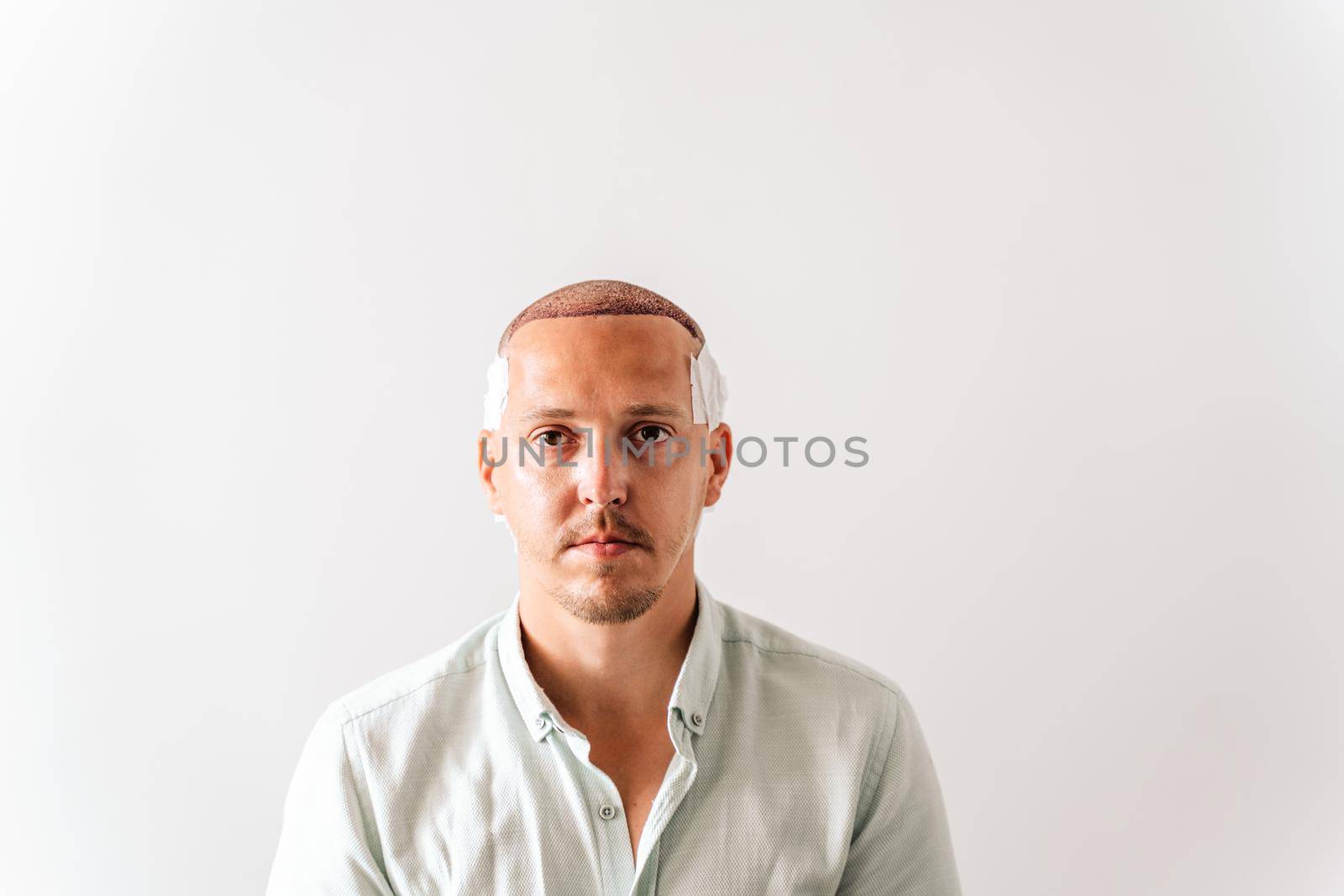 After hair transplantation surgical technique that moves hair follicles. Young bald man in bandage with hair loss problems. White background with copy space.