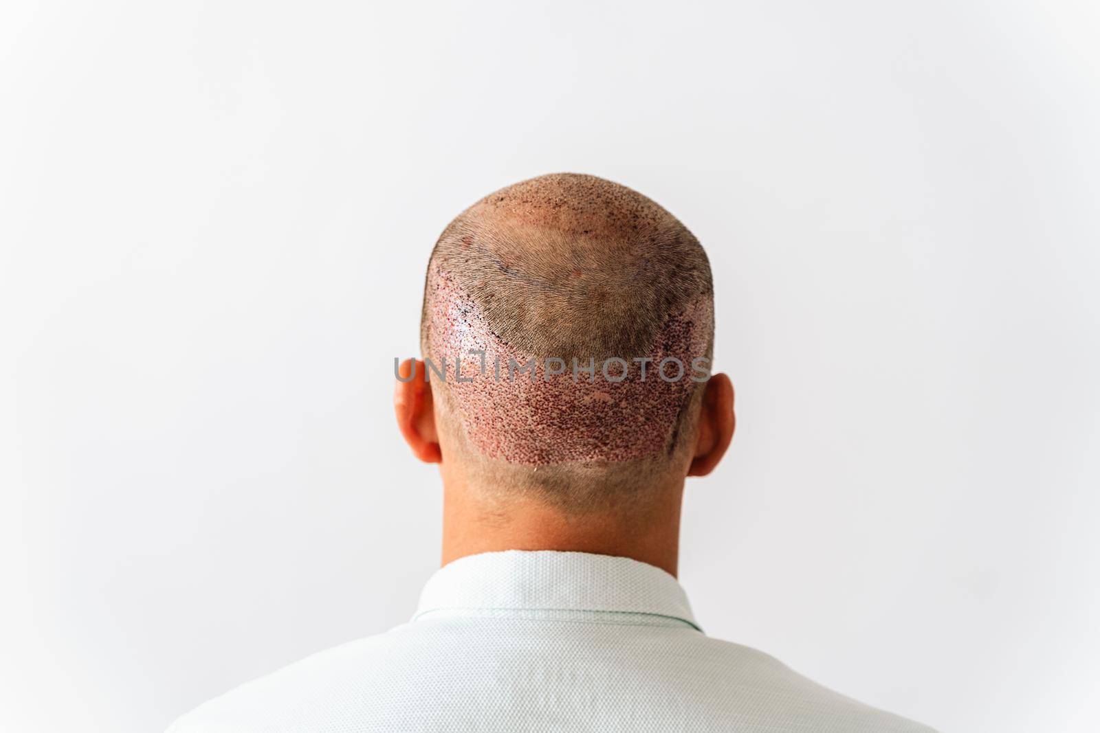 After hair transplantation surgical technique that moves hair follicles. Young bald man with hair loss problems. White background with copy space.