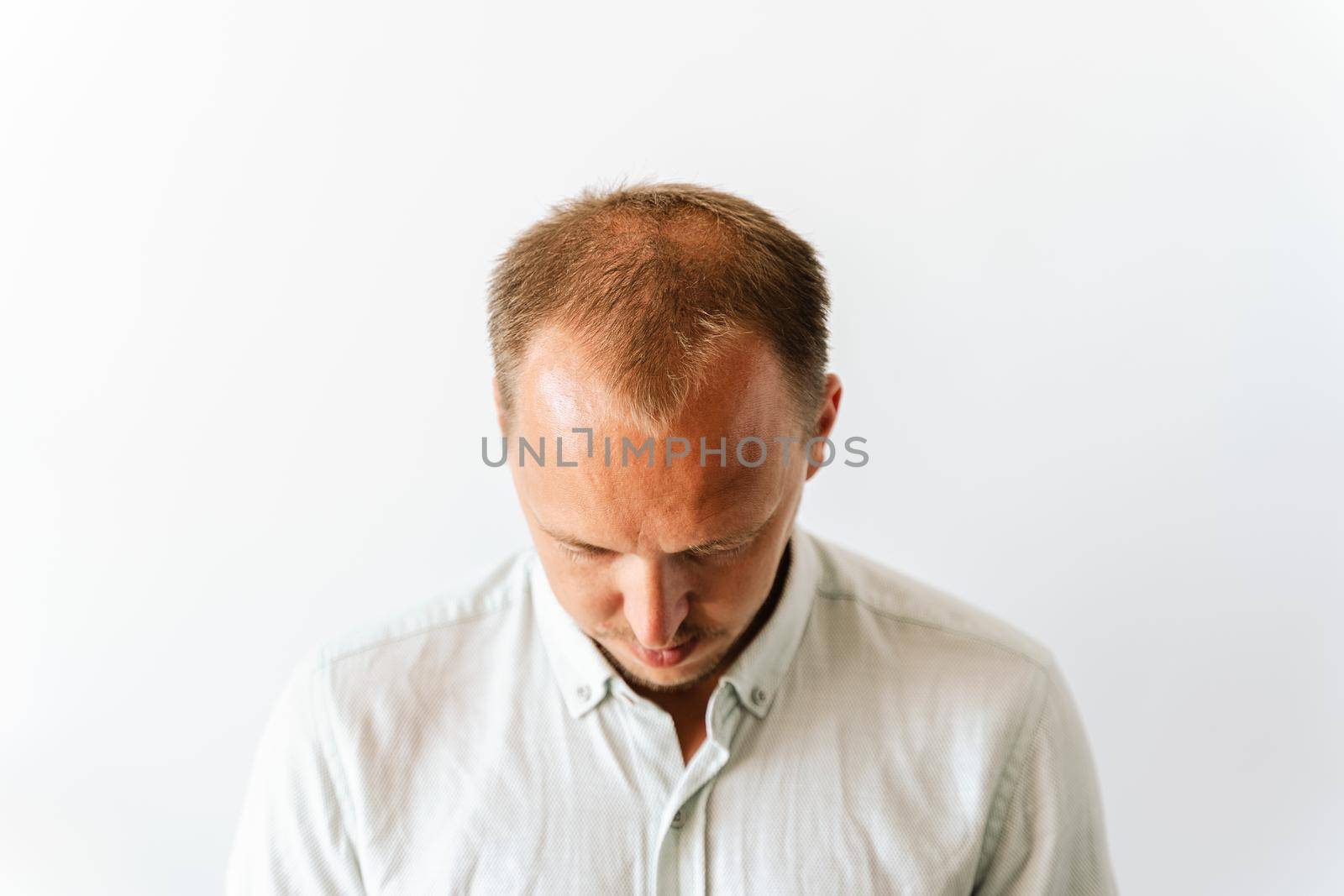 Before hair transplantation. Young bald man with hair loss problems. White background with copy space