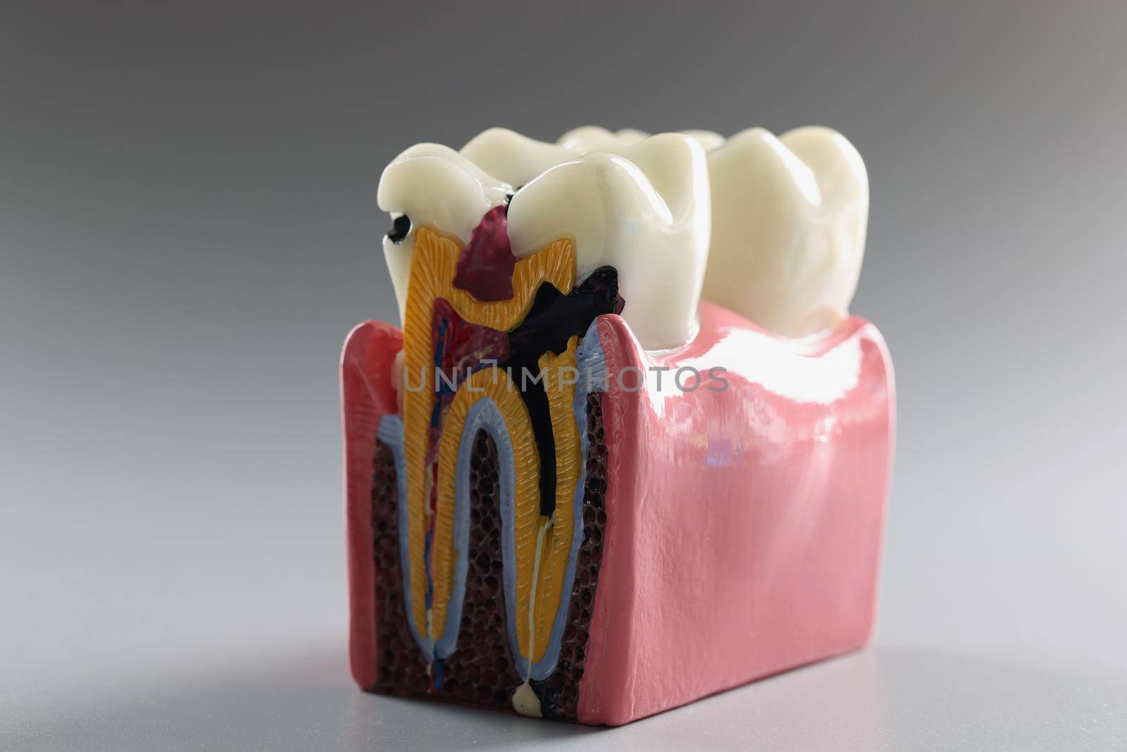 Teaching model of a tooth in cross section on a gray background, close-up. Learning resources for dentistry. Dental fillings