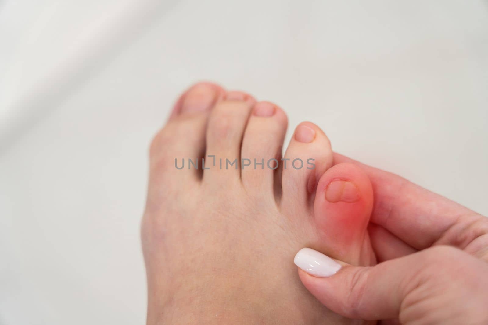 Inflammation on female foot with red spot. Concept of feet pain and disease by Mariakray