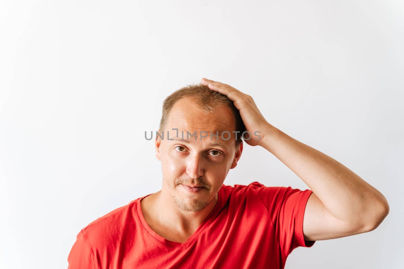 Before hair transplantation. Young bald man with hair loss problems holding his head.