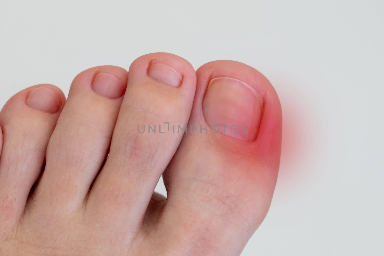 Inflammation on female foot with red spot. Concept of feet disease and pain