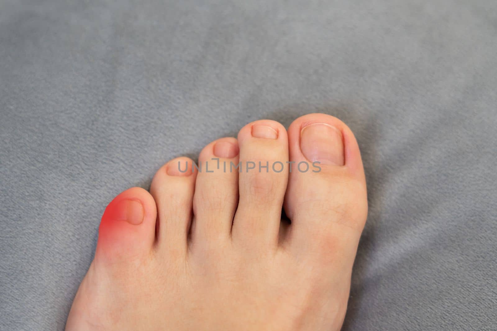 Inflammation on female foot with red spot. Concept of feet disease and pain