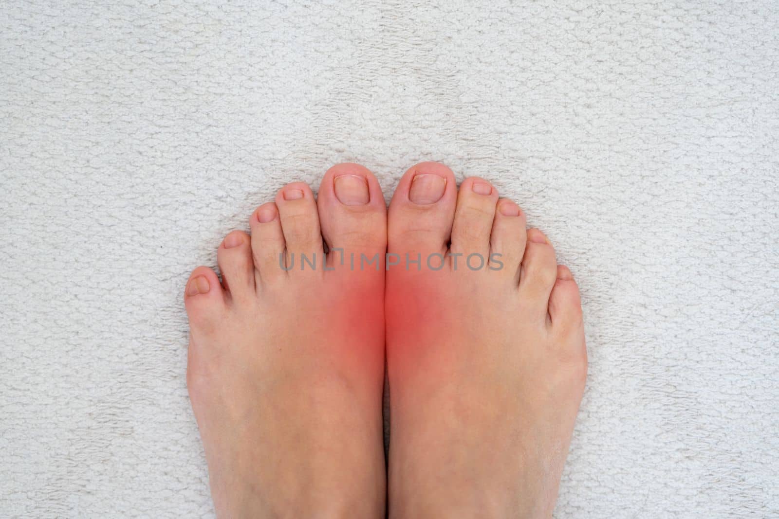 Toe pain may cause from bone fracture, tendinitis, ligament sprain, osteoarthritis, gouty arthritis, rheumatoid arthritis.