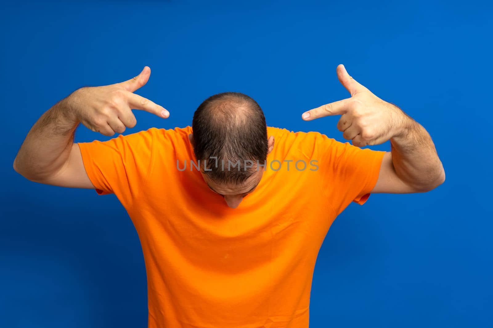 Human alopecia or hair loss. Middle-aged Latino man pointing to his head highlighting his incipient alopecia.