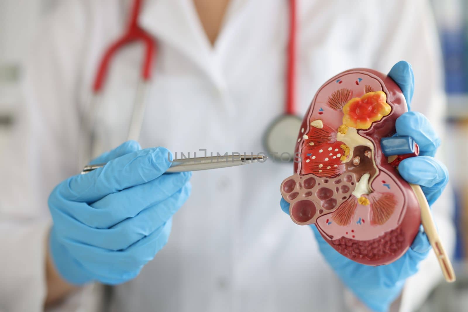 Doctor in hospital is standing holding anatomical model of kidney. Nephrology kidney transplant surgery and diseases concept