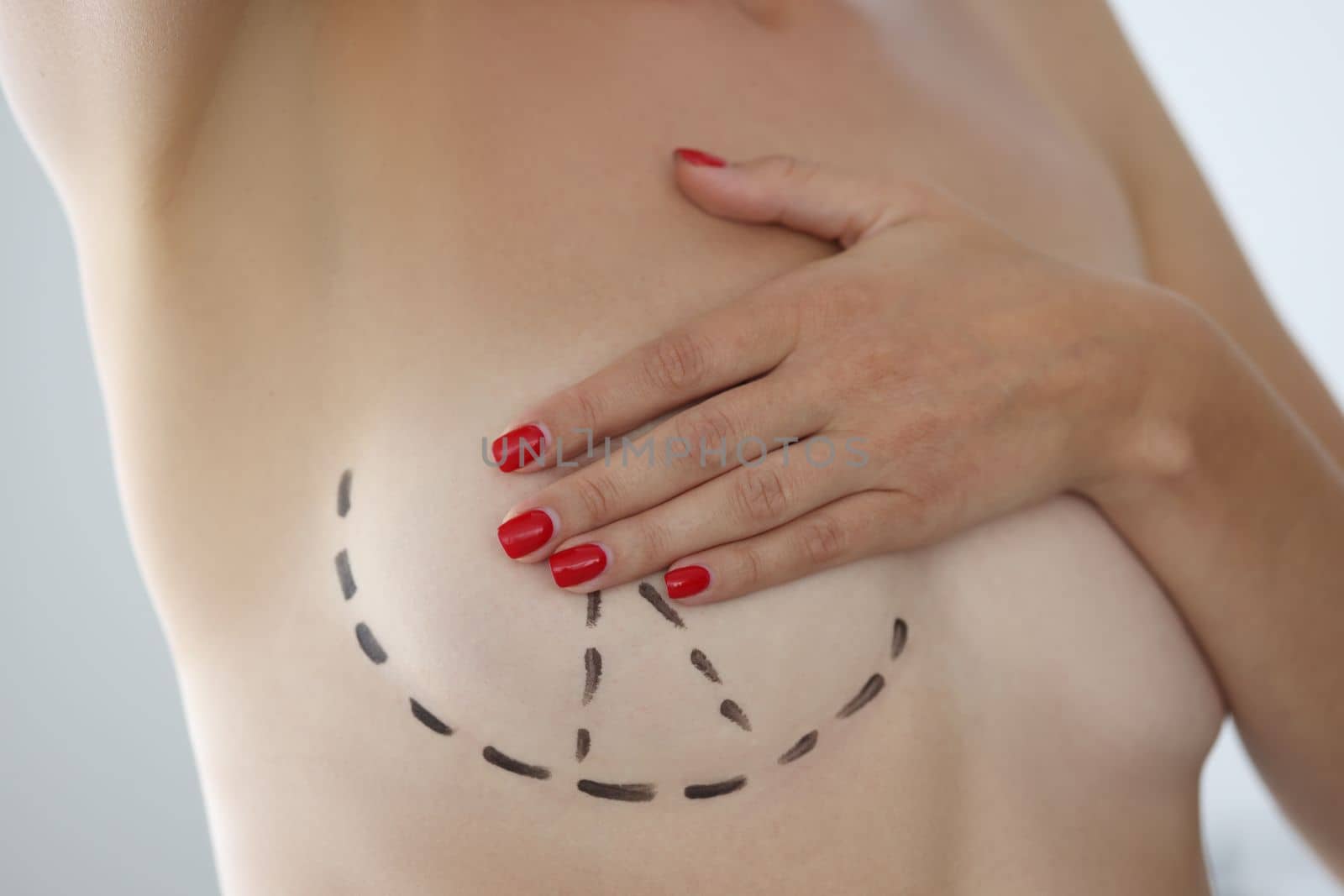 Female breast and black marks for surgery. Breast lift mastopexy and breast augmentation concept