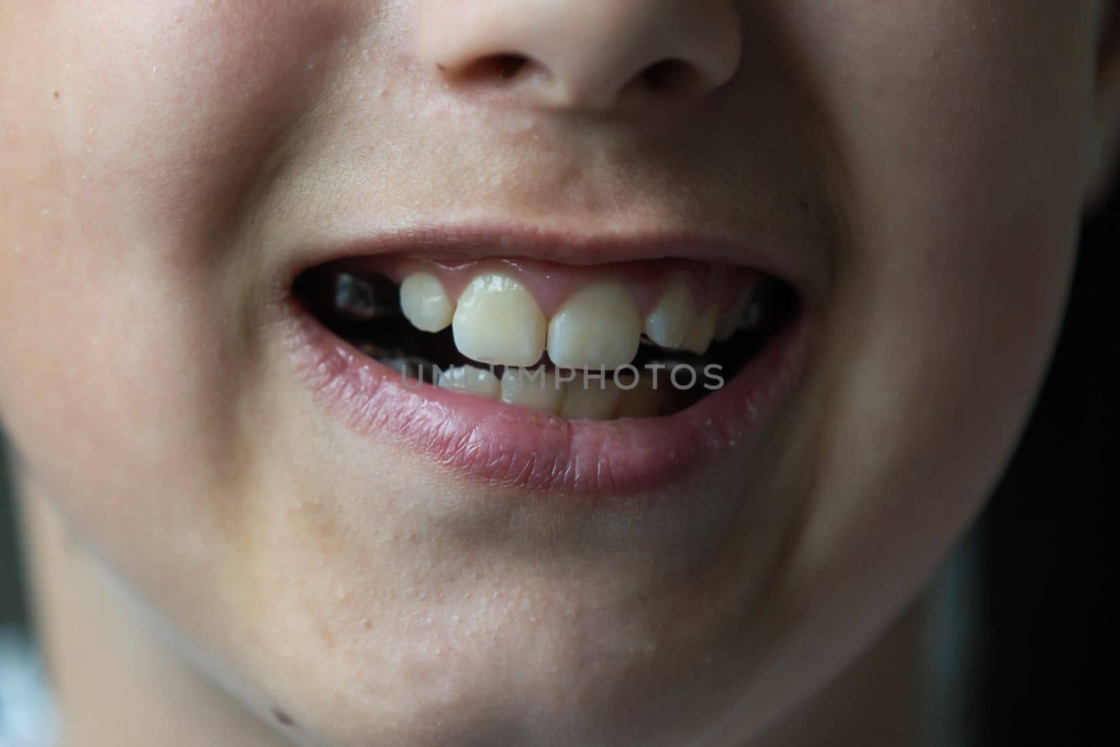 a little girl with a shifted dentition demonstrates her teeth by Andelov13