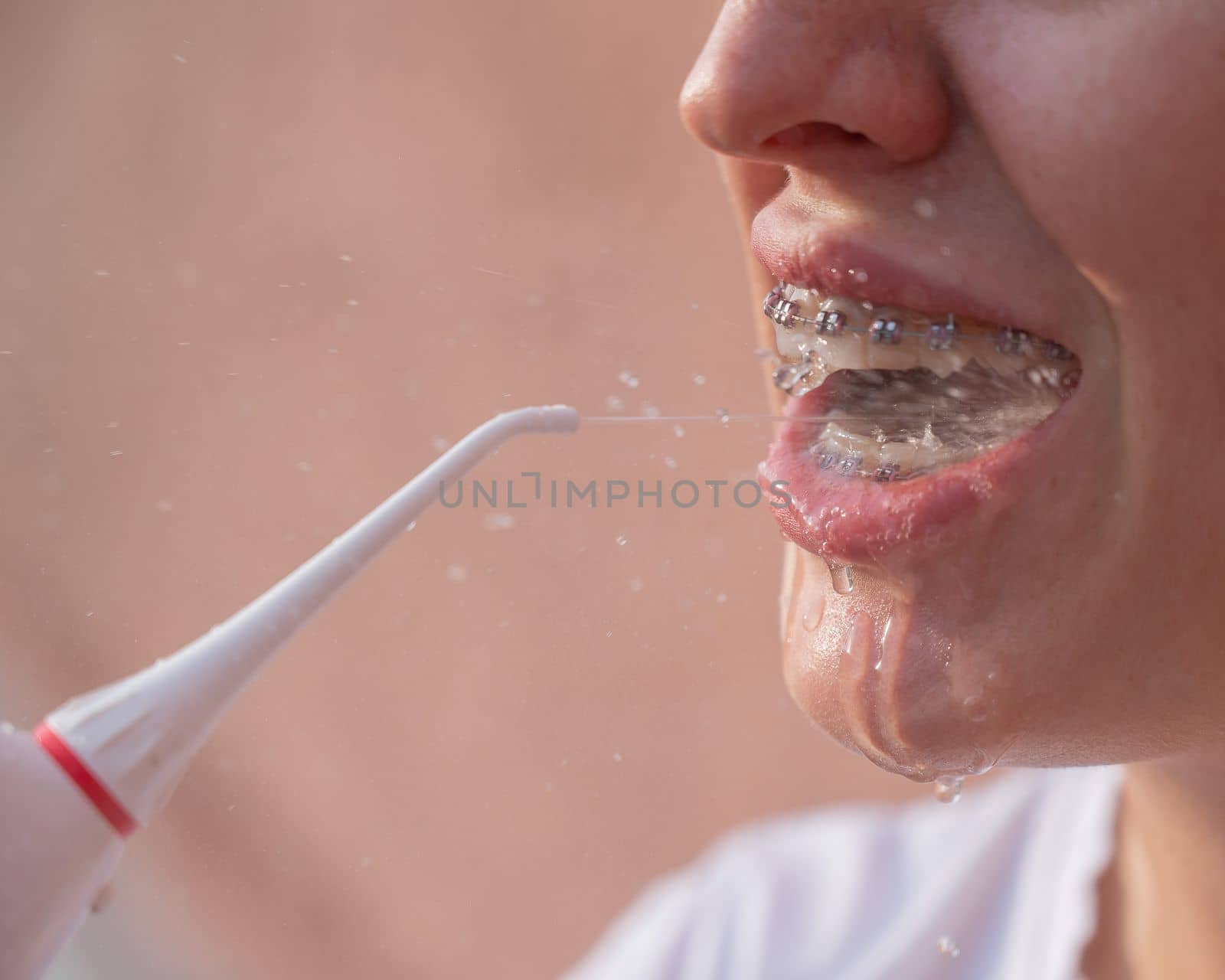A woman with braces on her teeth uses an irrigator. Close-up portrait