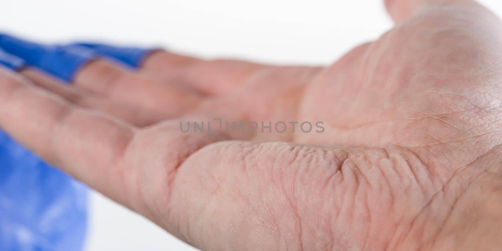 The doctor takes off his blue rubber gloves, the skin on his hands is wrinkled from moisture. Wrinkled fingers after wearing rubber gloves for a long time