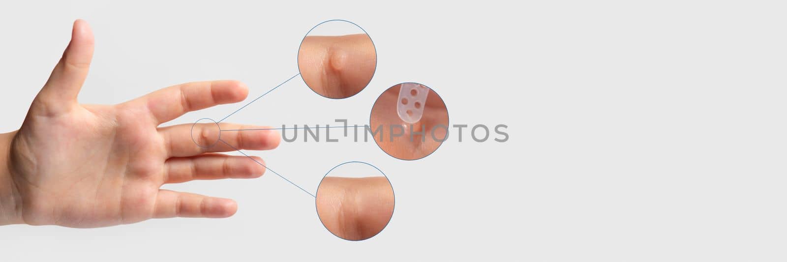 Wart on the finger. Close-up of wart treatment before and after. Apply the medicine to the wart. Human papillomavirus, HPV, copy space